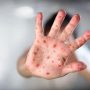 Kasus Flu Singapura mengalami kenaikan di Indonesia (iStockphoto RomoloTavani).