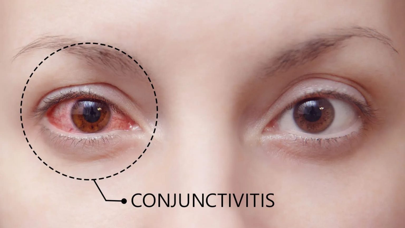 Konjungtivitis