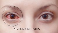 Konjungtivitis