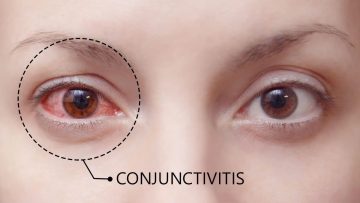 Konjungtivitis