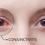 Konjungtivitis