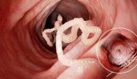 Ilustrasi Raya meninggal usai cacing bersarang di dalam tubuhnya (national geographic).