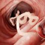Ilustrasi Raya meninggal usai cacing bersarang di dalam tubuhnya (national geographic).
