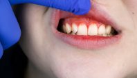 Periodontitis