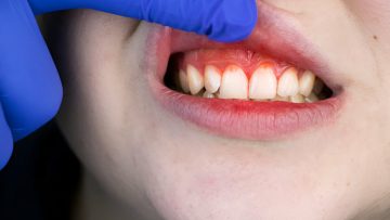 Periodontitis