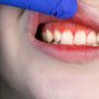 Periodontitis