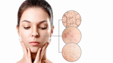 Kulit Bermasalah Saat Musim Hujan